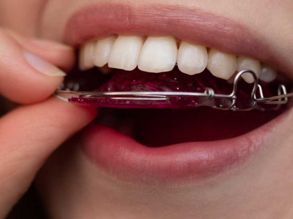 چرا باید بعد از ارتودنسی ریتینر گذاشت؟