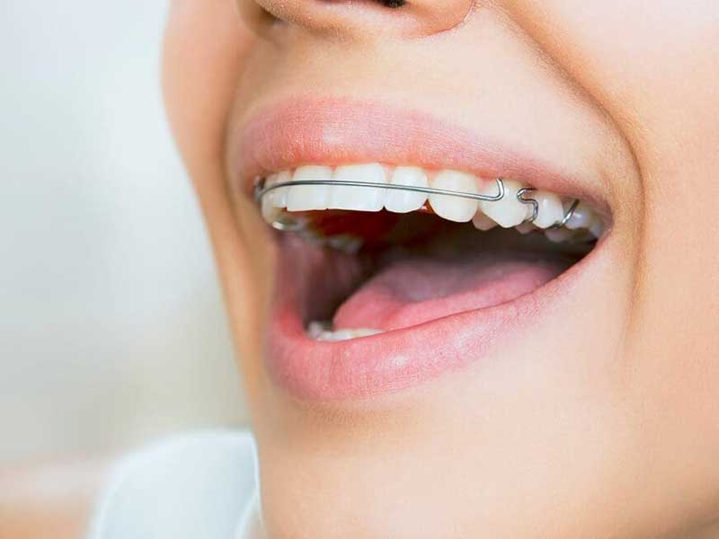 چرا باید بعد از ارتودنسی ریتینر گذاشت؟