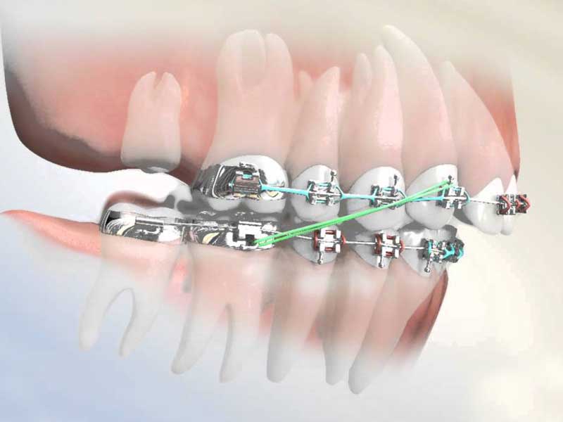 کشیدن دندان عقل برای ارتودنسی