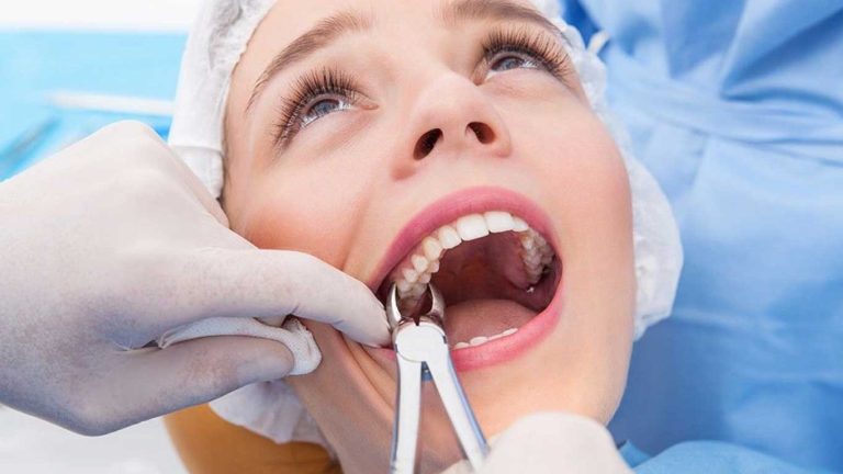 کشیدن دندان عقل برای ارتودنسی