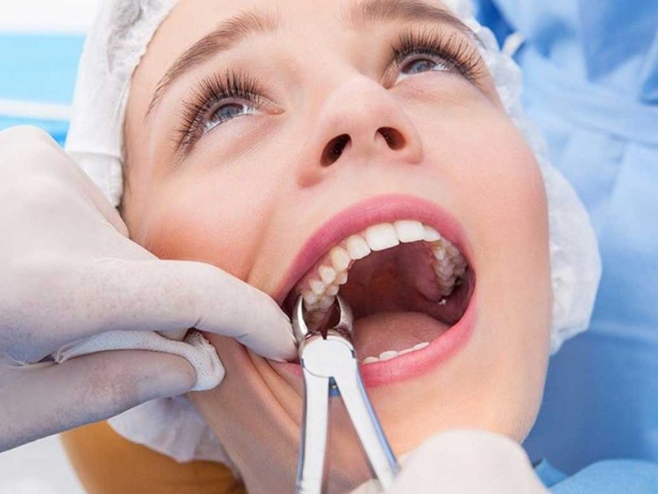 کشیدن دندان عقل برای ارتودنسی