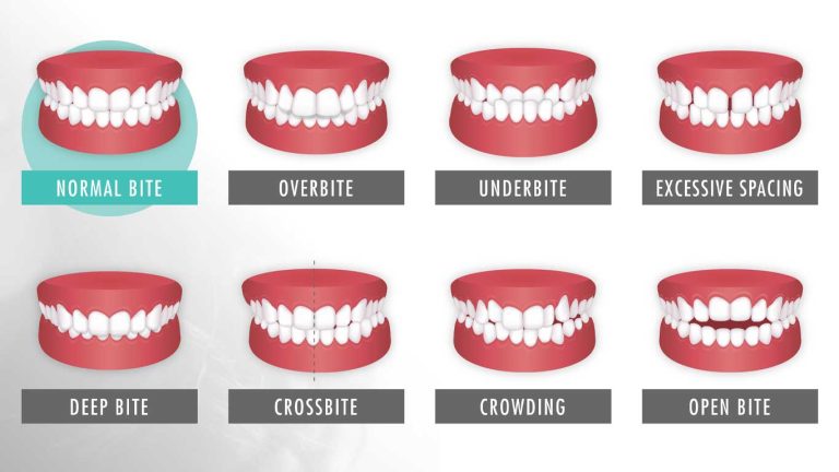 انواع بایت‌ های دندانی