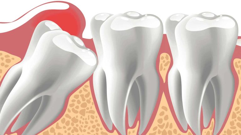 دندان نهفته