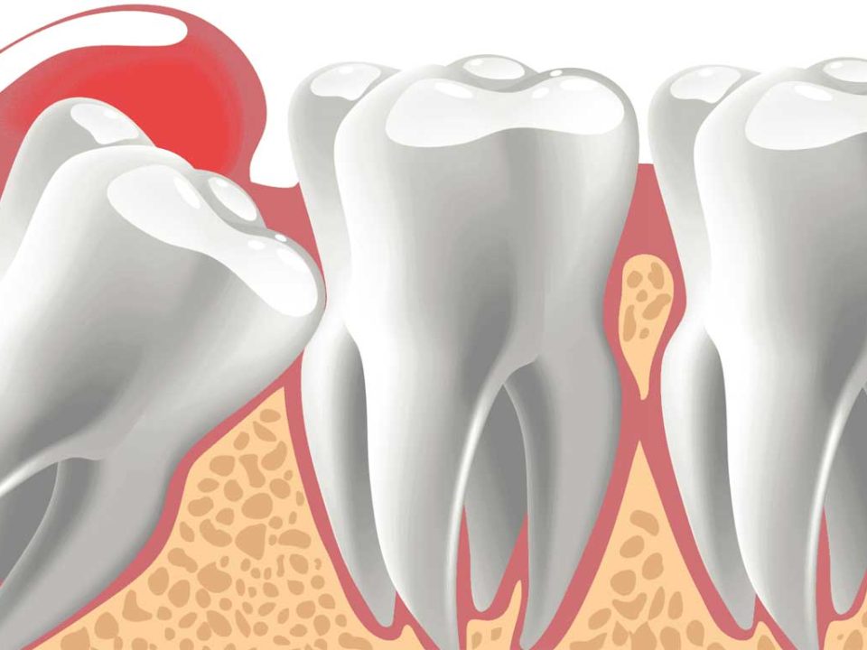 دندان نهفته