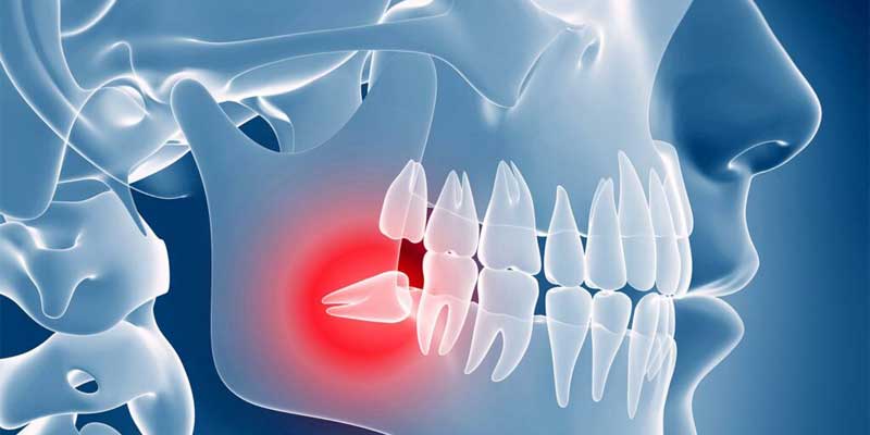 دندان نهفته