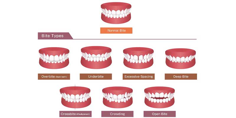 انواع بایت‌ های دندانی