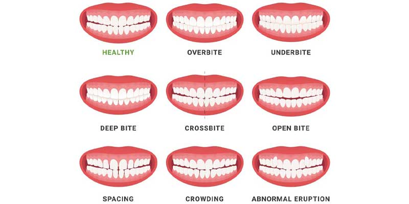 انواع بایت‌ های دندانی