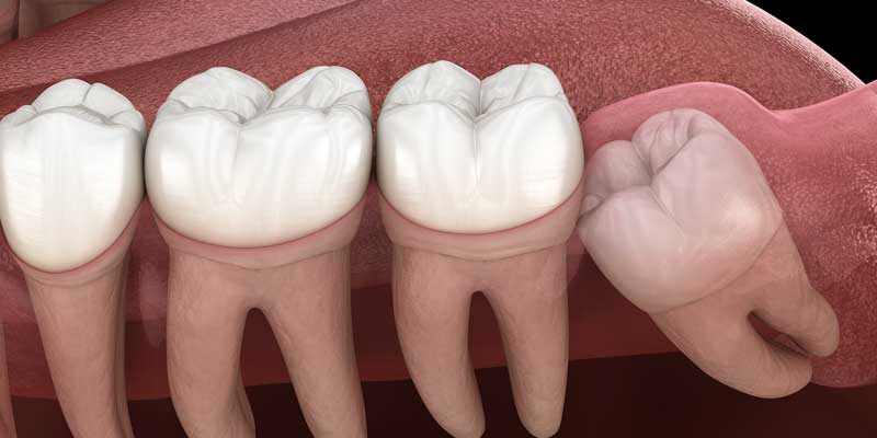 دندان نهفته