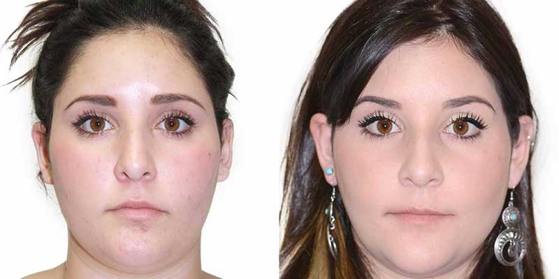 فک نامتقارن