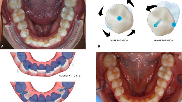 درمان چرخش و جابجایی دندان