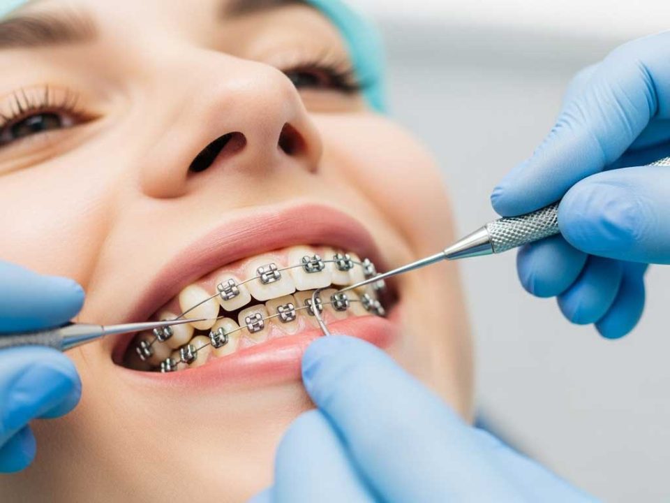 جرم گیری دندان در ارتودنسی