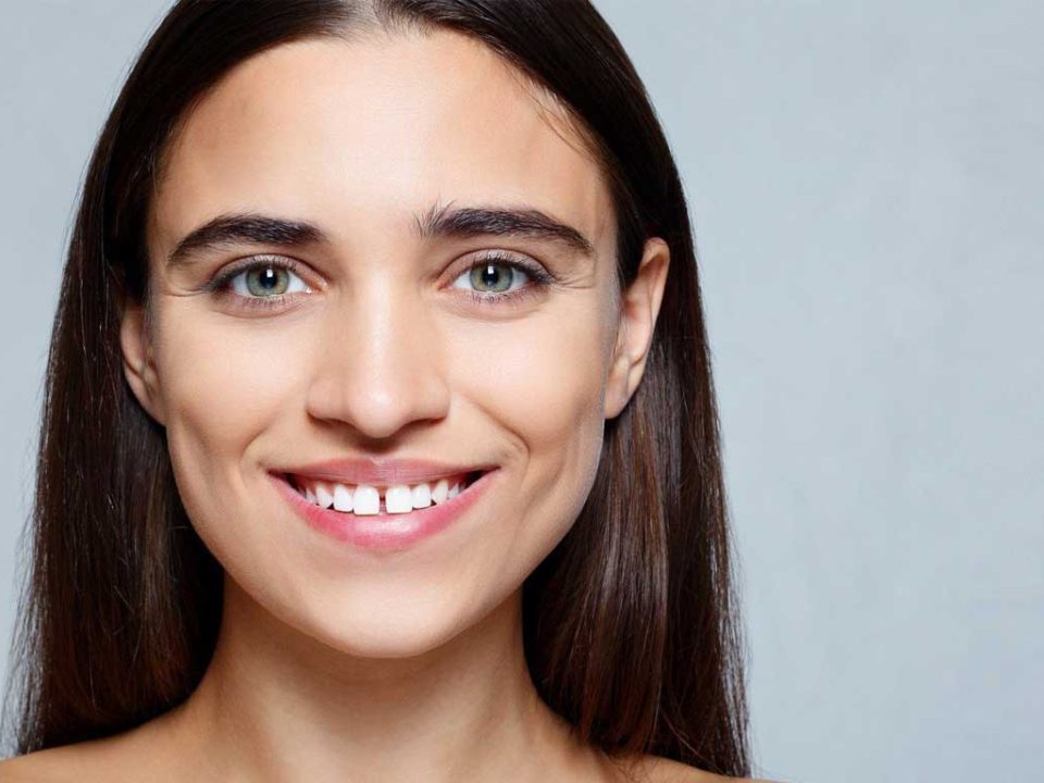 فاصله بین دندان یا دیاستم