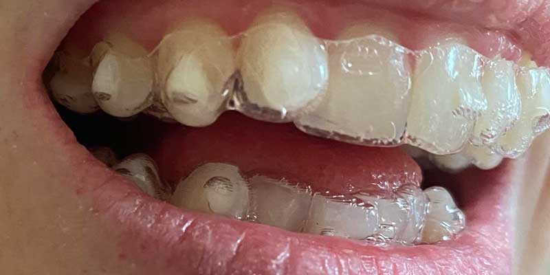 درمان چرخش و جابجایی دندان