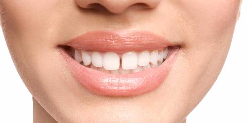 فاصله بین دندان یا دیاستم