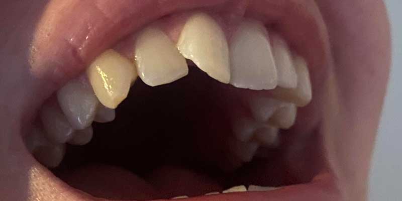 درمان چرخش و جابجایی دندان