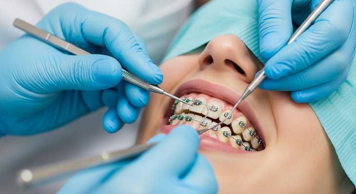 جرم گیری دندان در ارتودنسی