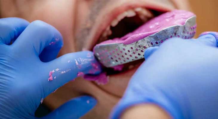 قالب گیری ارتودنسی