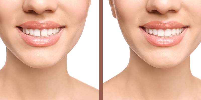 فاصله بین دندان یا دیاستم