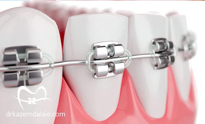 هزینه خدمات ارتودنسی در پاسداران