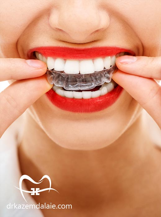 ارتودنسی نامرئی در تهران