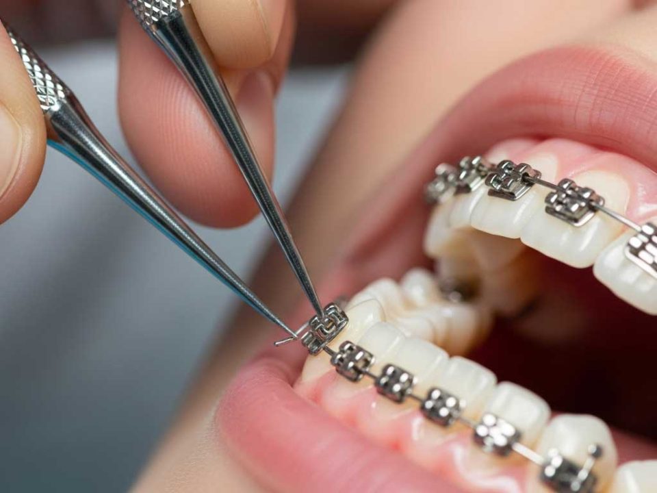 باندینگ ارتودنسی