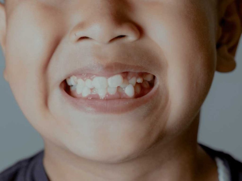 دندان اضافه