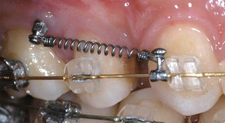 مینی اسکرو ارتودنسی