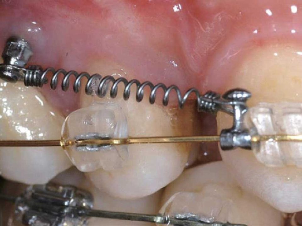 مینی اسکرو ارتودنسی