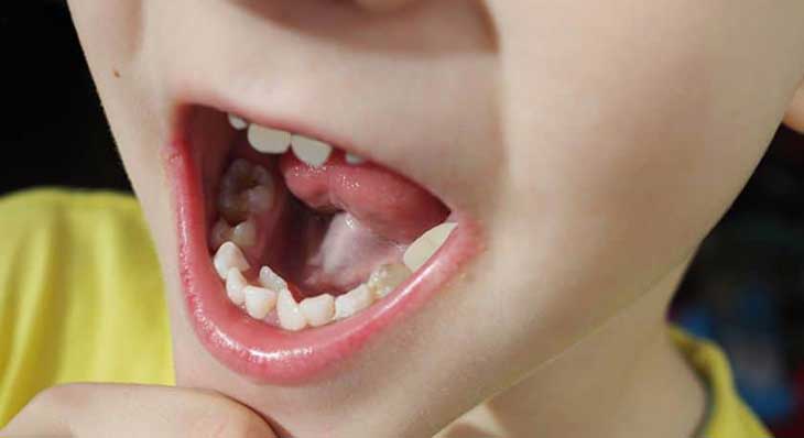 دندان اضافه