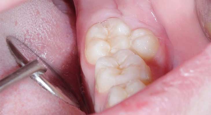 دندان اضافه