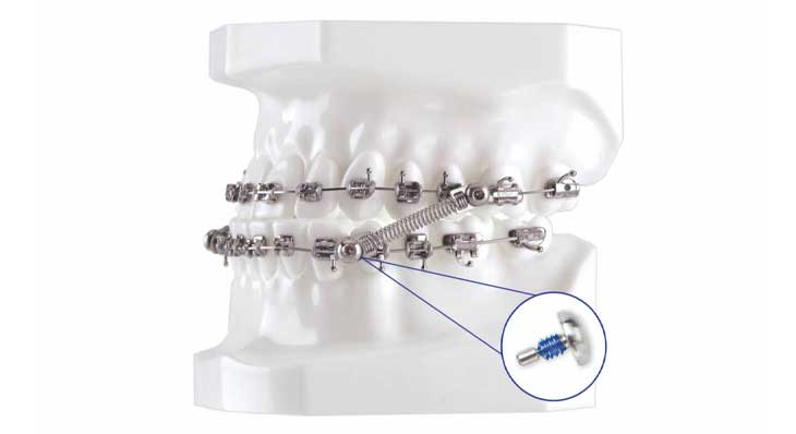 مینی اسکرو ارتودنسی