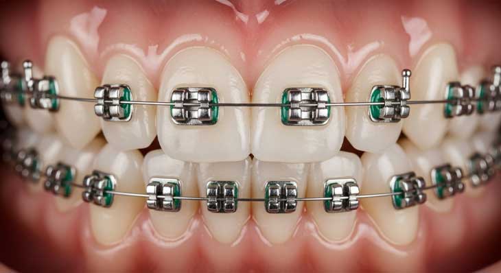 صاف کردن دندان کج