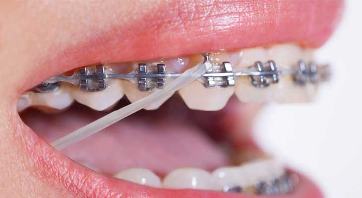 ارتودنسی دندان نیش