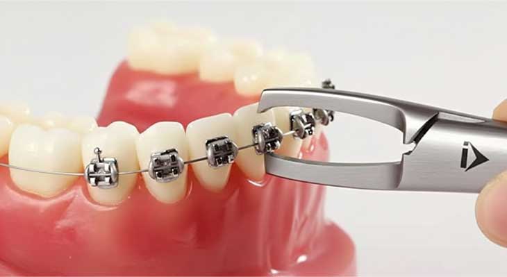برداشتن ارتودنسی دندان