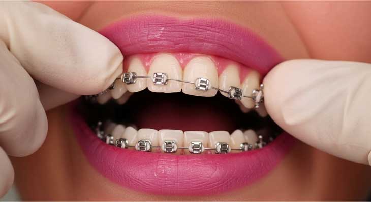 شل شدن براکت ارتودنسی