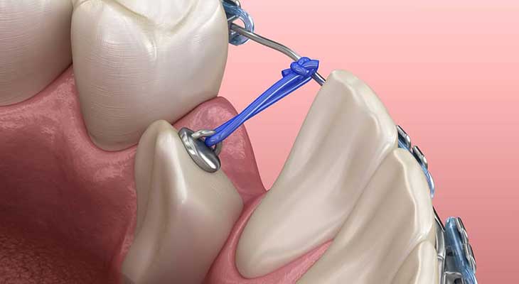 درمان دندان نیش نهفته