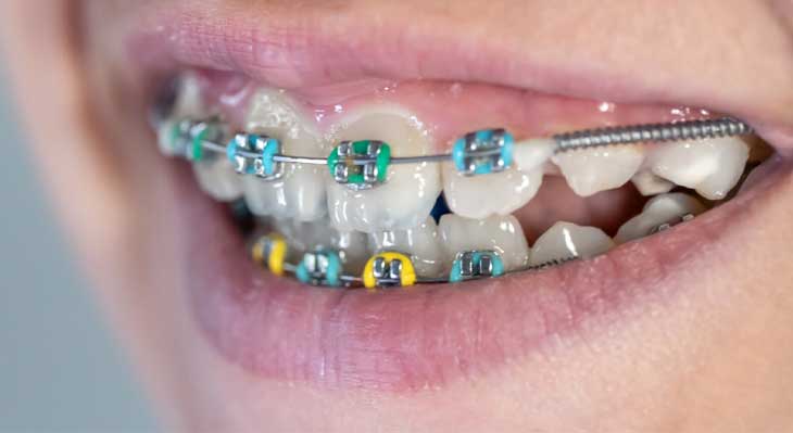 ارتودنسی دندان نیش