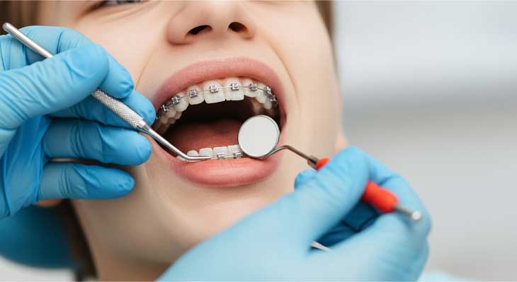 برداشتن ارتودنسی دندان