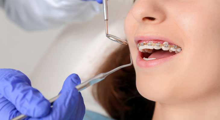 پوسیدگی دندان در ارتودنسی