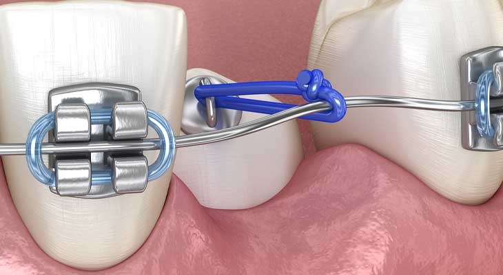 درمان دندان نیش نهفته