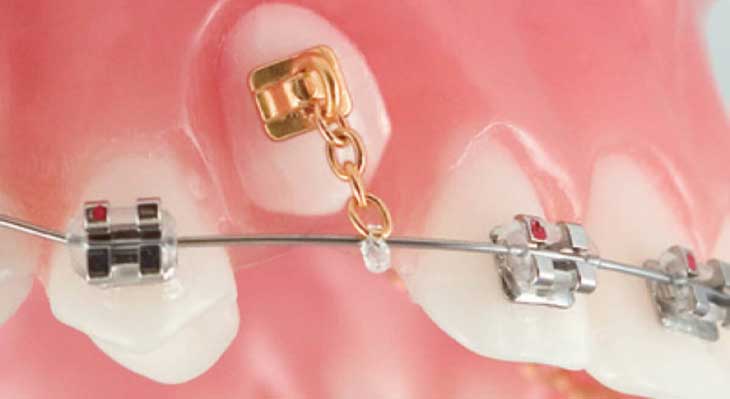 ارتودنسی دندان نیش