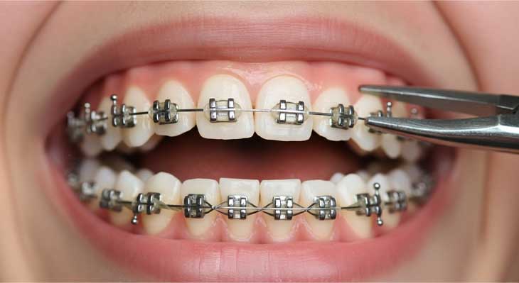 برداشتن ارتودنسی دندان