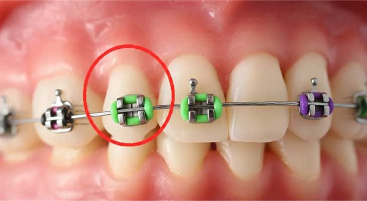 شل شدن براکت ارتودنسی