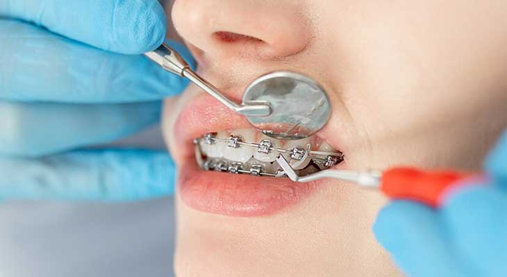 پوسیدگی دندان در ارتودنسی