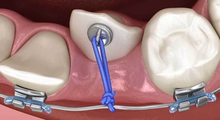 درمان دندان نیش نهفته