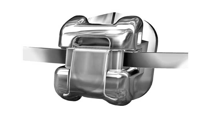 تفاوت ارتودنسی دیمون و ثابت