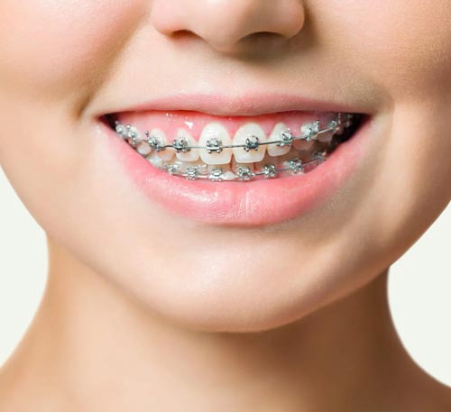 ارتودنسی ثابت کودکان