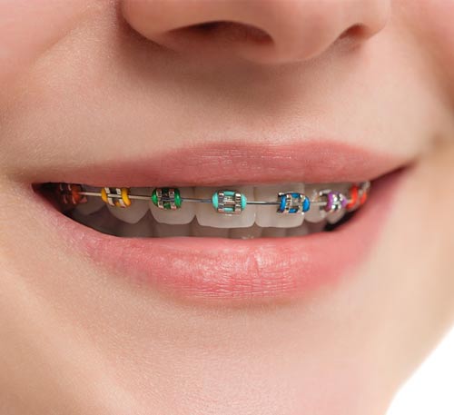 ارتودنسی رنگی کودکان