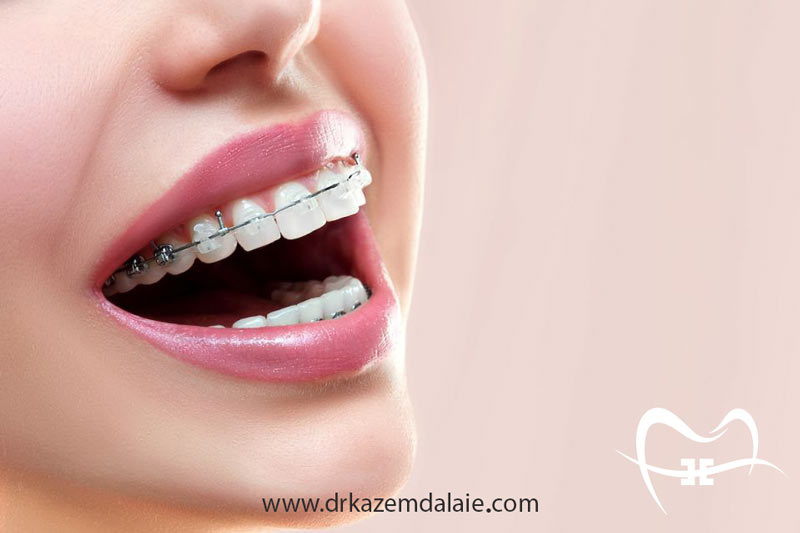 بهترین متخصص ارتودنسی در قلهک