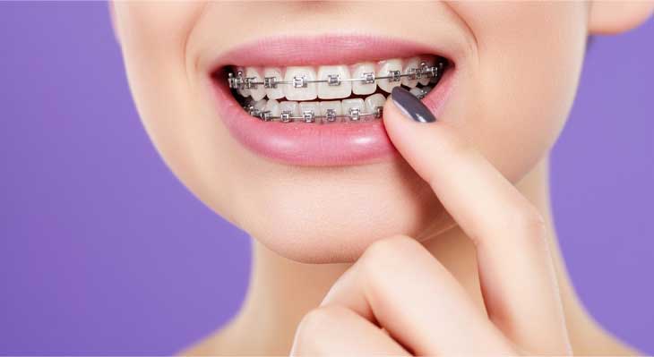 لق شدن دندان در ارتودنسی